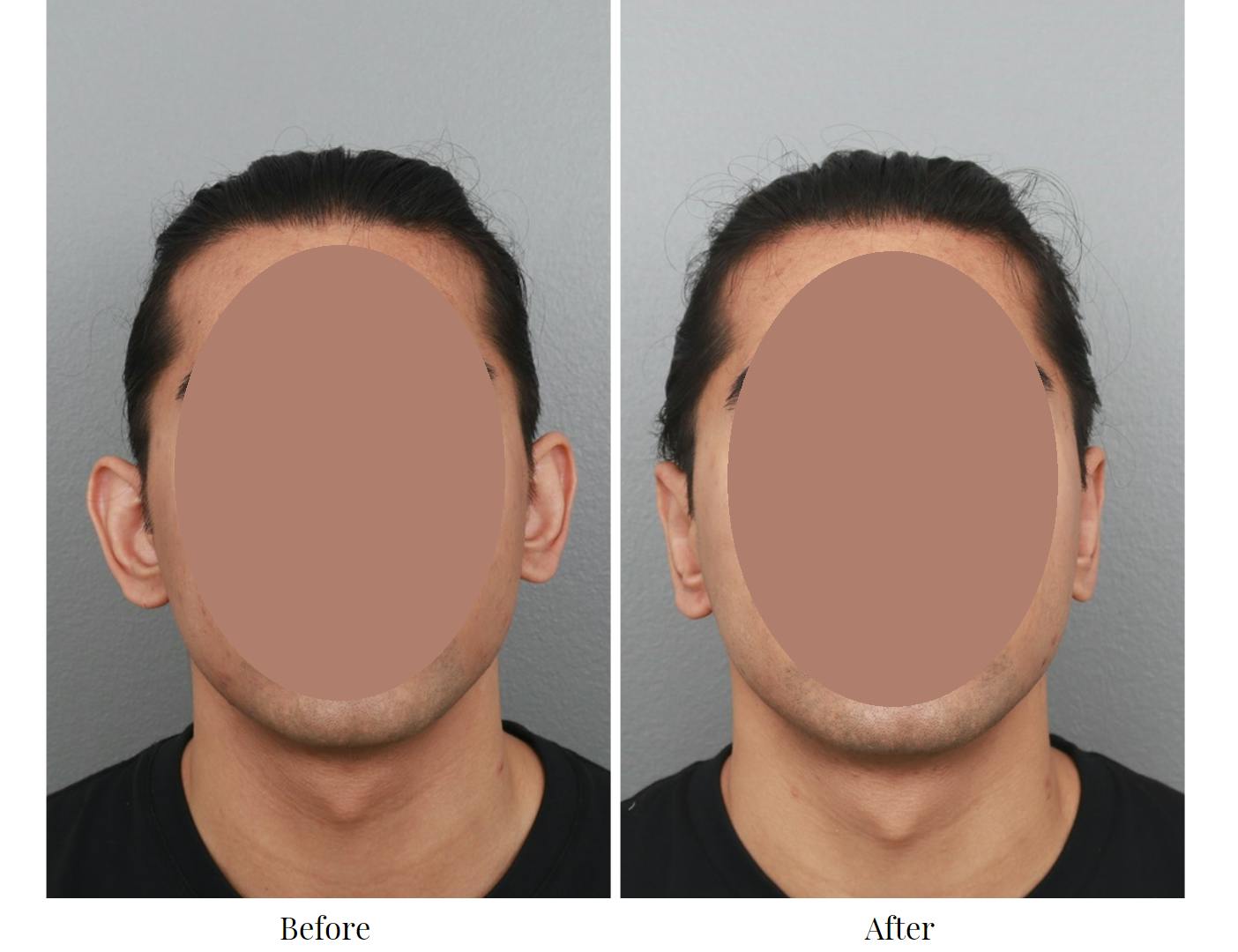 Ear Pinning (Otoplasty) Before & After Gallery - Patient 64081113 - Image 1