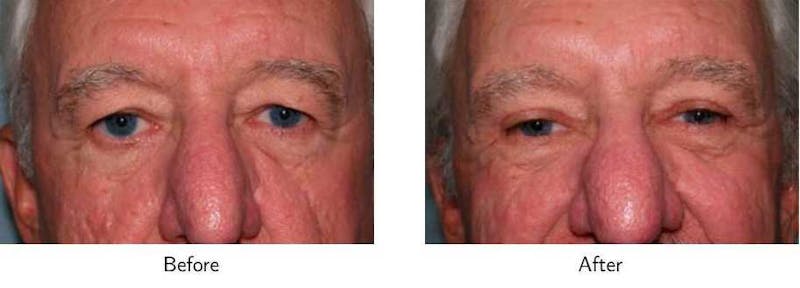 Blepharoplasty Before & After Gallery - Patient 64081110 - Image 1