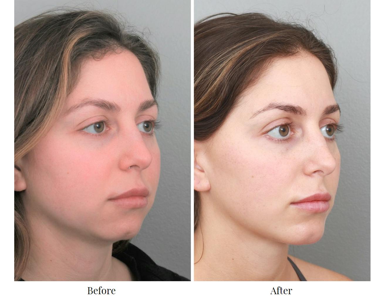 Chin Augmentation Before & After Gallery - Patient 64081117 - Image 3