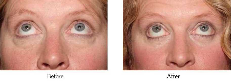 Blepharoplasty Before & After Gallery - Patient 64081111 - Image 2