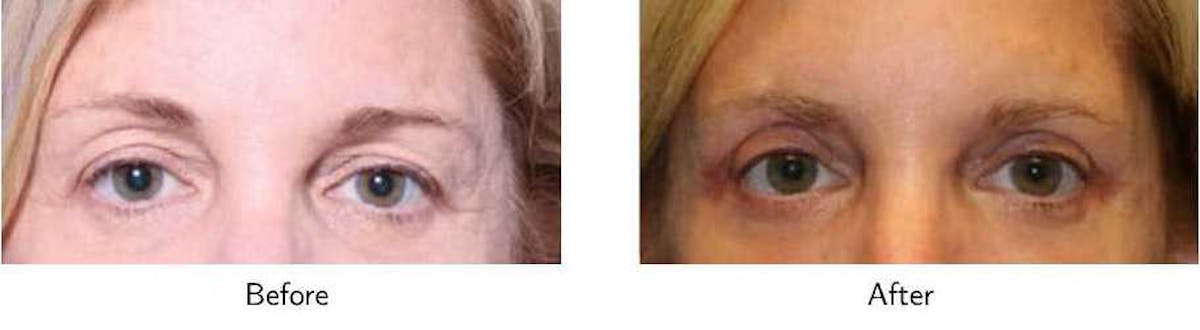 Blepharoplasty Before & After Gallery - Patient 64081114 - Image 1