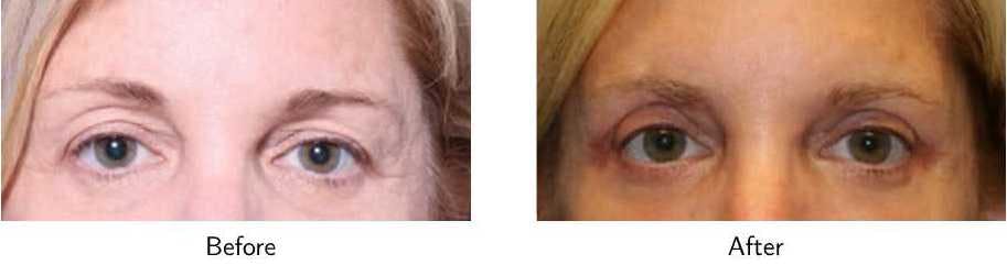 Blepharoplasty Before & After Gallery - Patient 64081114 - Image 1