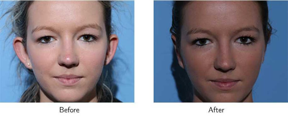 Ear Pinning (Otoplasty) Before & After Gallery - Patient 64081115 - Image 1