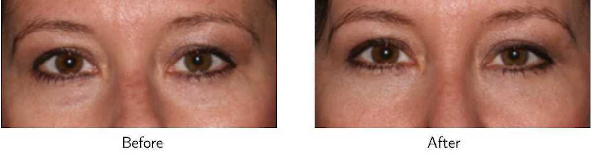 Blepharoplasty Before & After Gallery - Patient 64081116 - Image 1