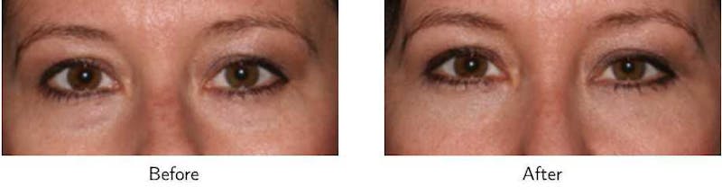 Blepharoplasty Before & After Gallery - Patient 64081116 - Image 1