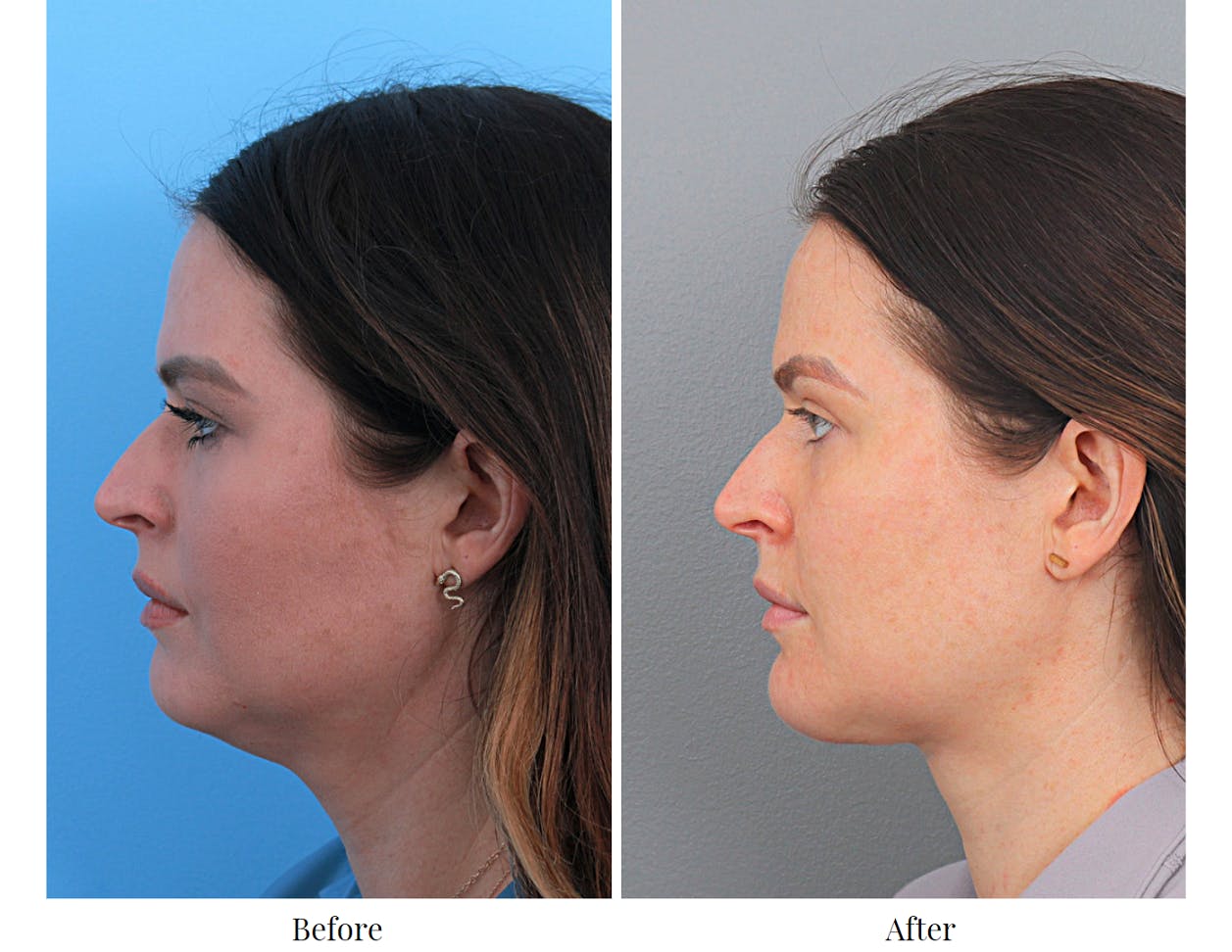 Chin Augmentation Before & After Gallery - Patient 64081127 - Image 2