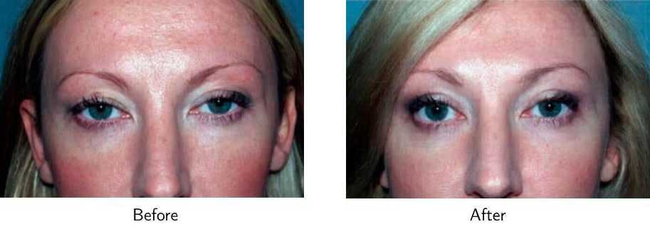 Blepharoplasty Before & After Gallery - Patient 64081118 - Image 1