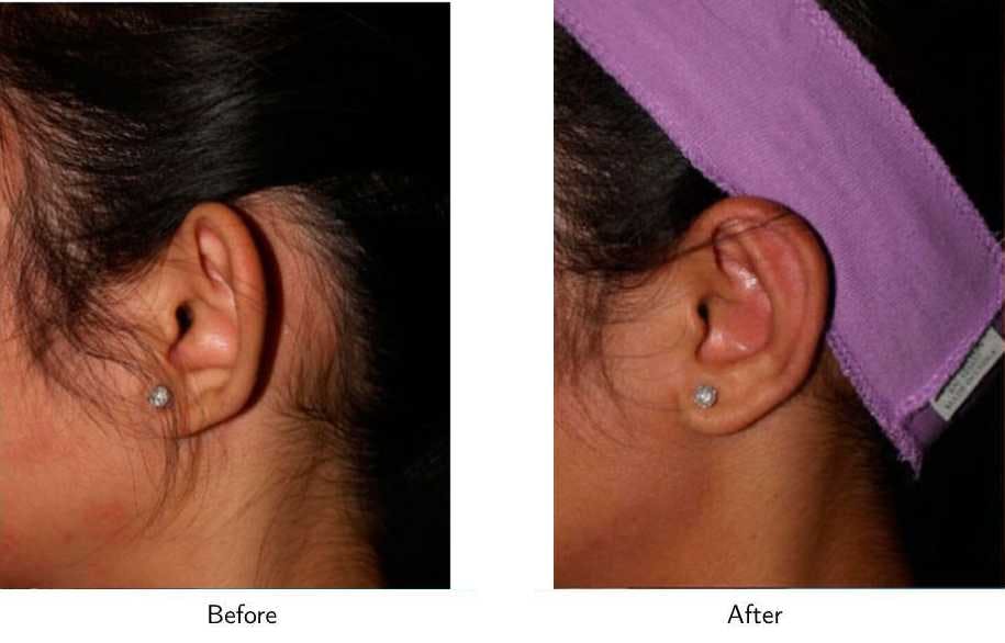 Ear Pinning (Otoplasty) Before & After Gallery - Patient 64081119 - Image 2
