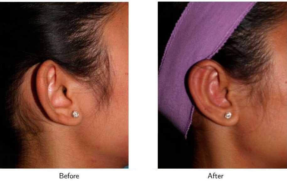 Ear Pinning (Otoplasty) Before & After Gallery - Patient 64081119 - Image 3