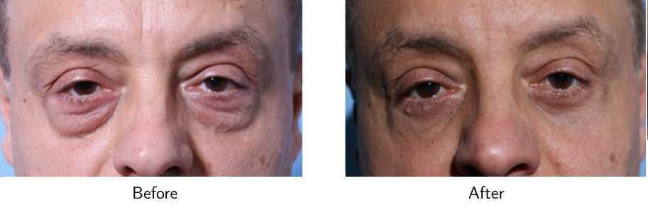 Blepharoplasty Before & After Gallery - Patient 64081120 - Image 1