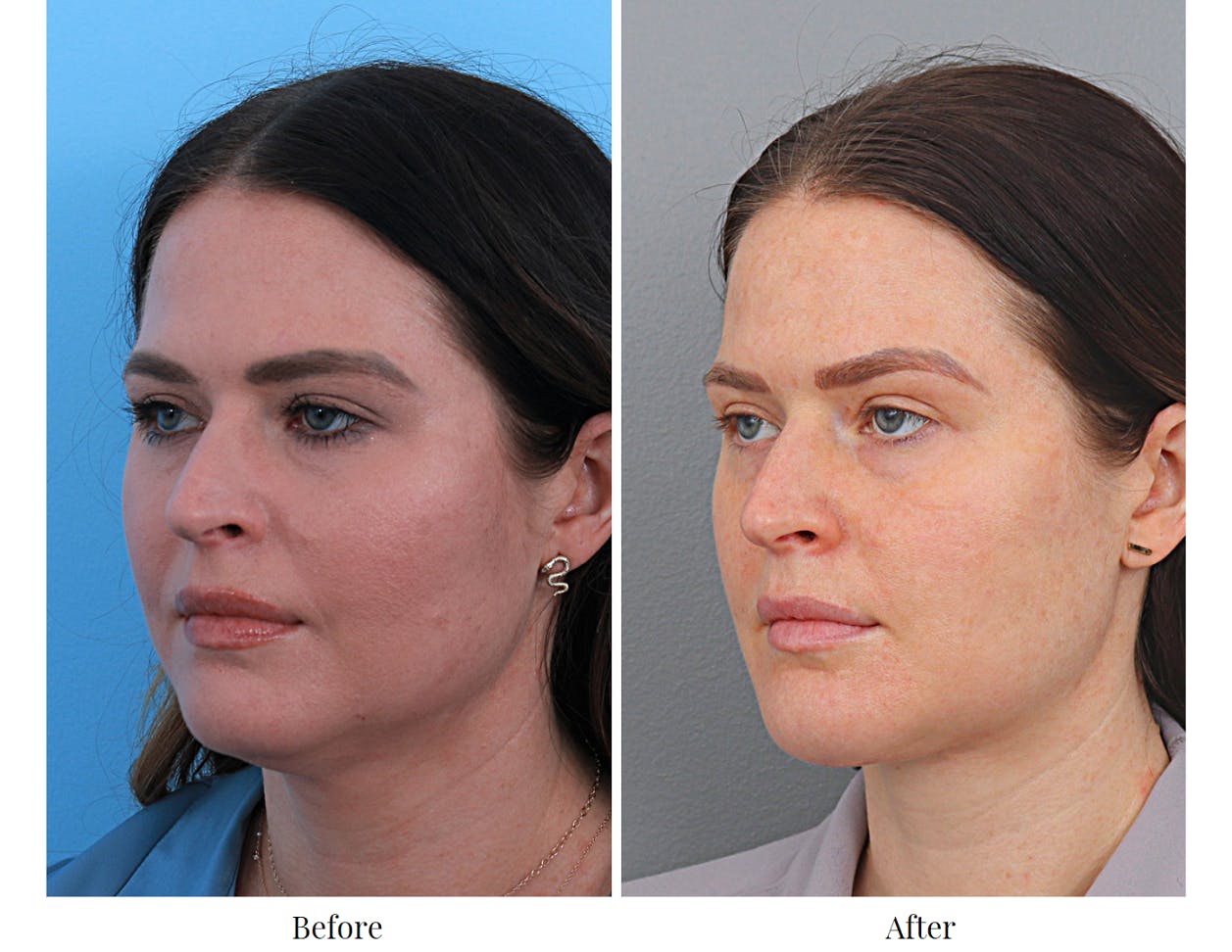 Chin Augmentation Before & After Gallery - Patient 64081127 - Image 3