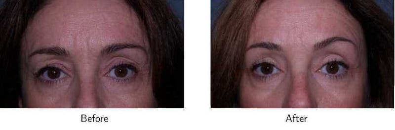 Blepharoplasty Before & After Gallery - Patient 64081121 - Image 1