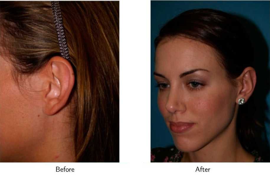 Ear Pinning (Otoplasty) Before & After Gallery - Patient 64081122 - Image 2