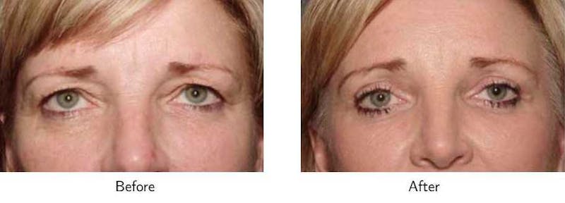 Blepharoplasty Before & After Gallery - Patient 64081123 - Image 1