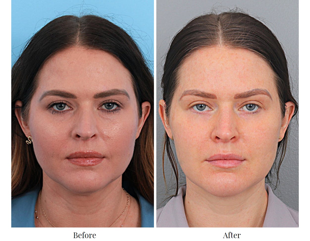 Chin Augmentation Before & After Gallery - Patient 64081127 - Image 4