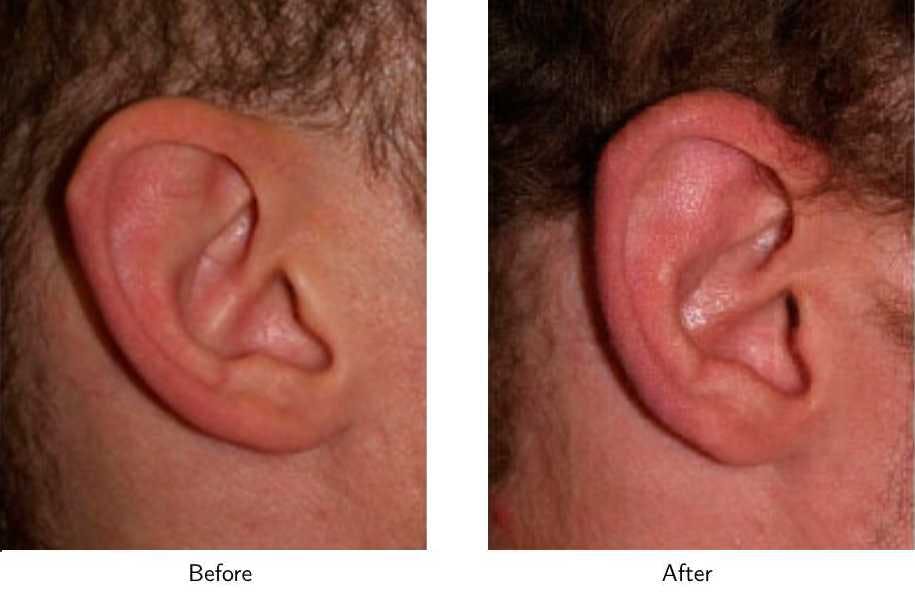 Ear Pinning (Otoplasty) Before & After Gallery - Patient 64081124 - Image 2