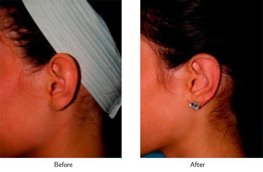 Ear Pinning (Otoplasty) Before & After Gallery - Patient 64081126 - Image 2