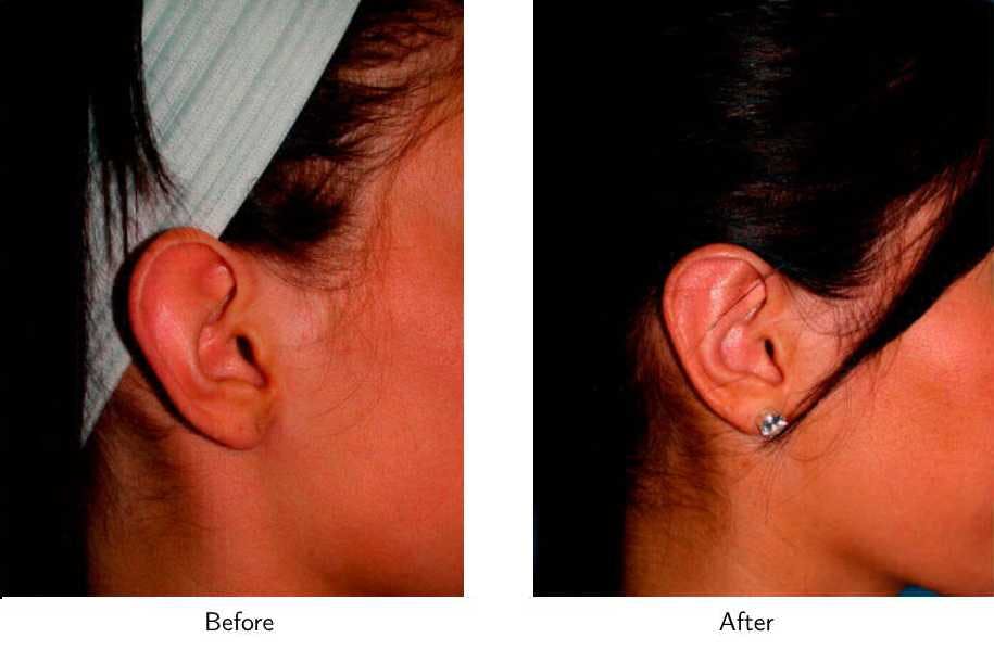 Ear Pinning (Otoplasty) Before & After Gallery - Patient 64081126 - Image 3