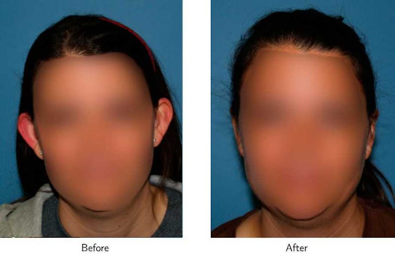 Ear Pinning (Otoplasty) Before & After Gallery - Patient 64081128 - Image 1