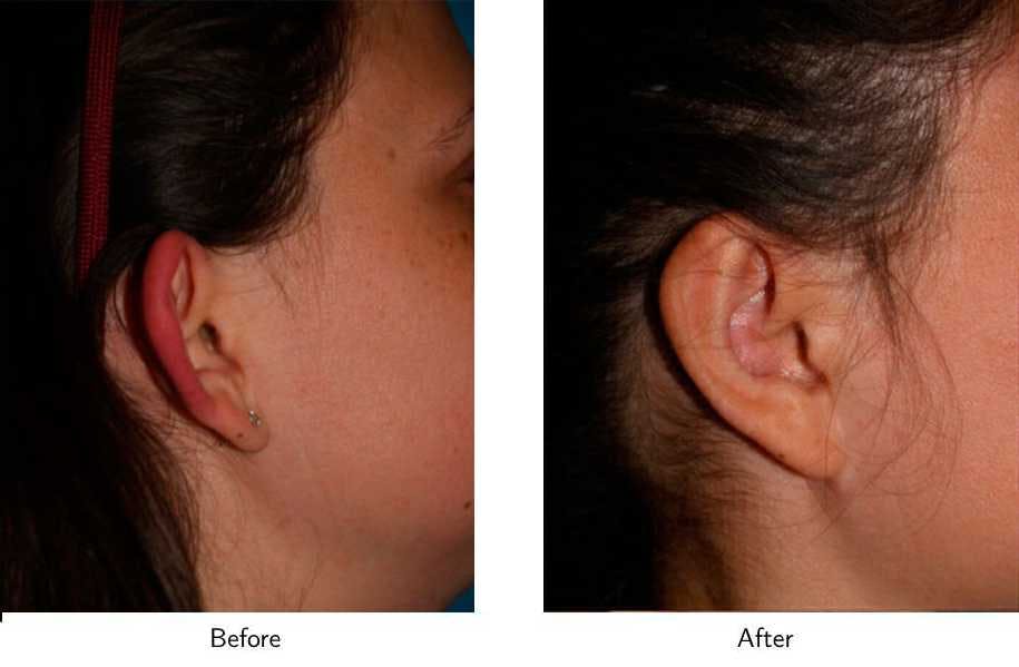 Ear Pinning (Otoplasty) Before & After Gallery - Patient 64081128 - Image 2