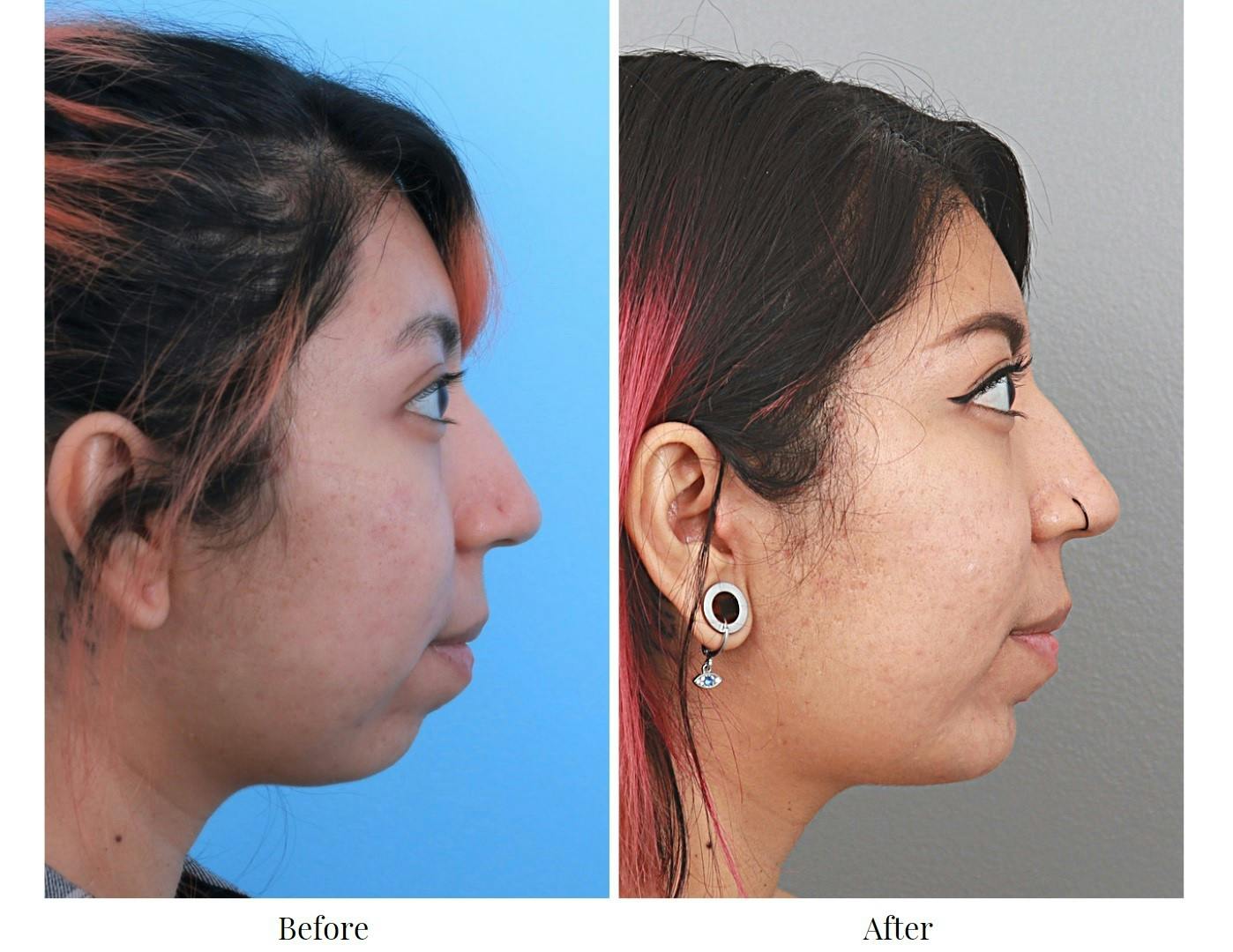 Chin Augmentation Before & After Gallery - Patient 64081130 - Image 2