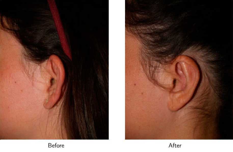 Ear Pinning (Otoplasty) Before & After Gallery - Patient 64081128 - Image 3