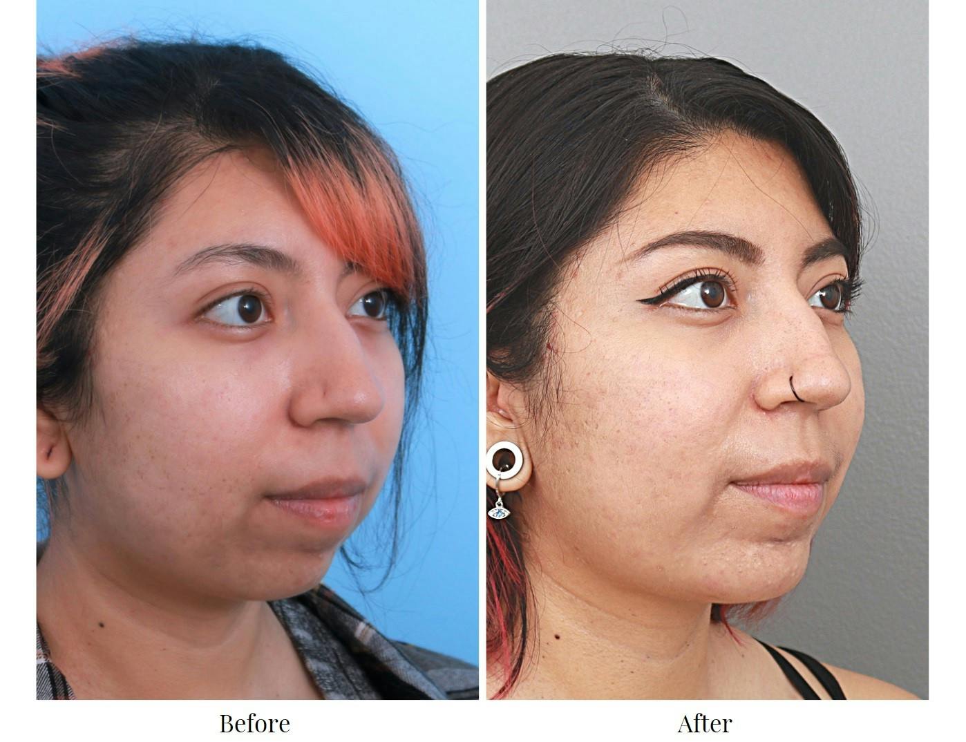 Chin Augmentation Before & After Gallery - Patient 64081130 - Image 1