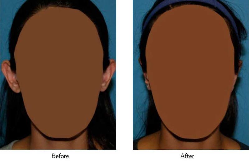 Ear Pinning (Otoplasty) Before & After Gallery - Patient 64081132 - Image 1
