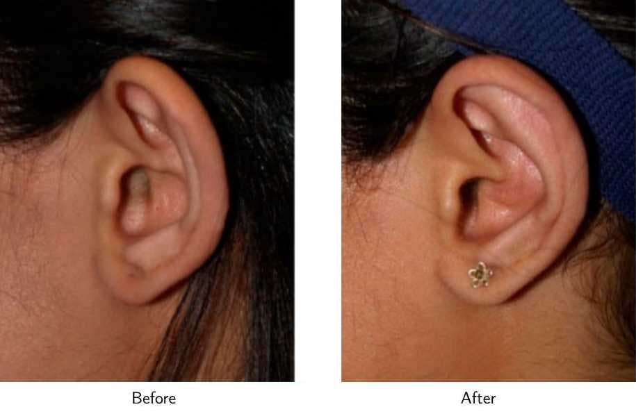 Ear Pinning (Otoplasty) Before & After Gallery - Patient 64081132 - Image 2