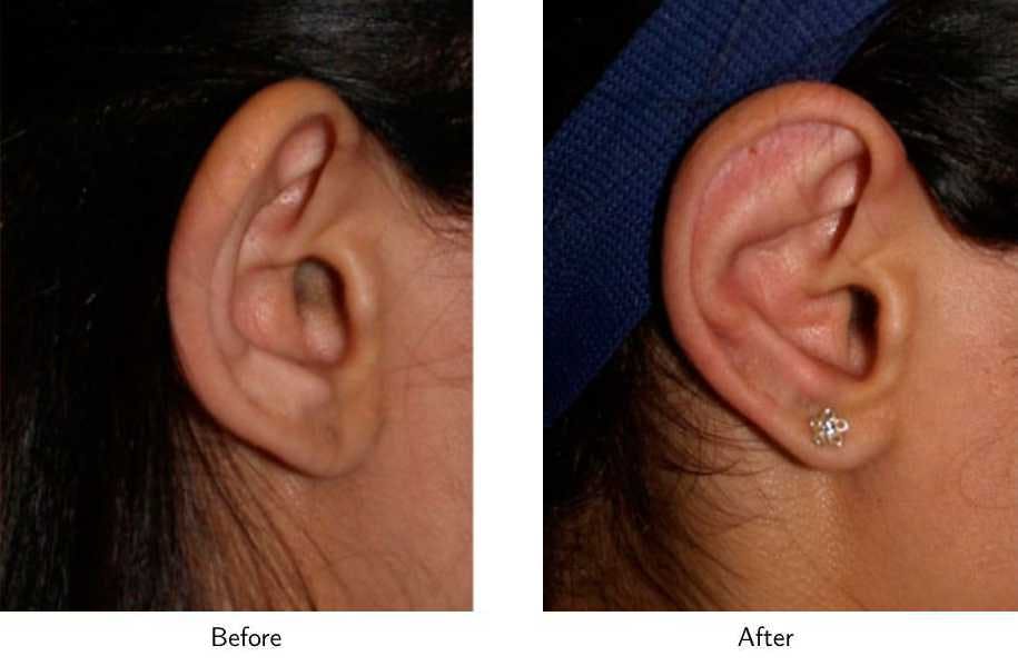 Ear Pinning (Otoplasty) Before & After Gallery - Patient 64081132 - Image 3