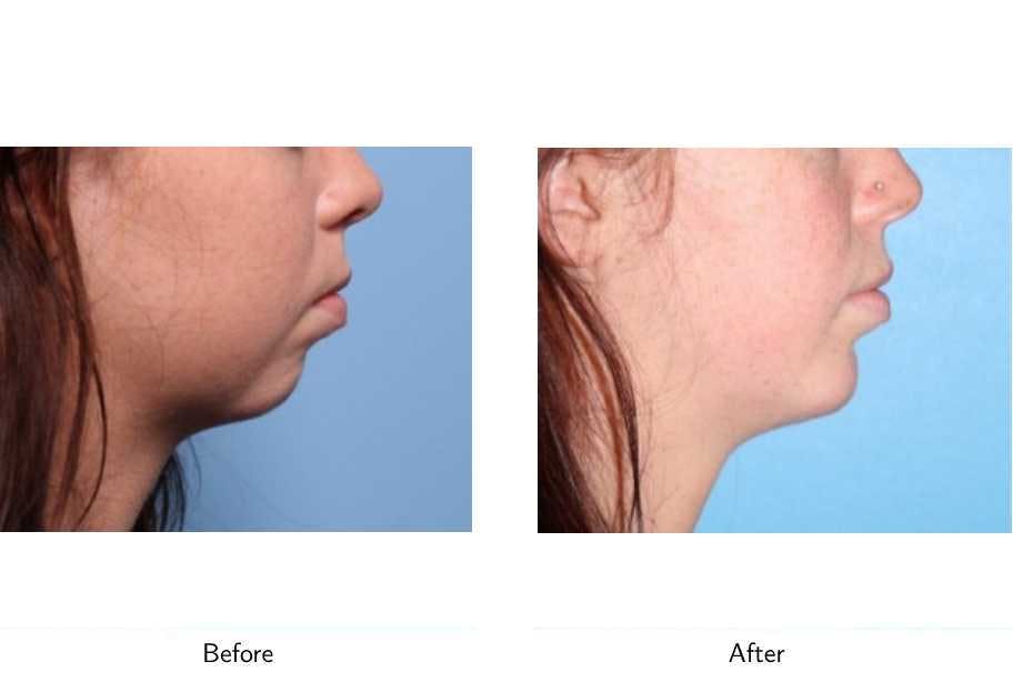 Chin Augmentation Before & After Gallery - Patient 64081133 - Image 2