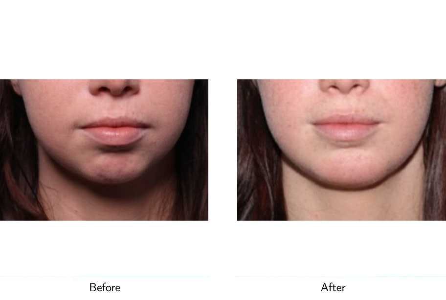 Chin Augmentation Before & After Gallery - Patient 64081133 - Image 3
