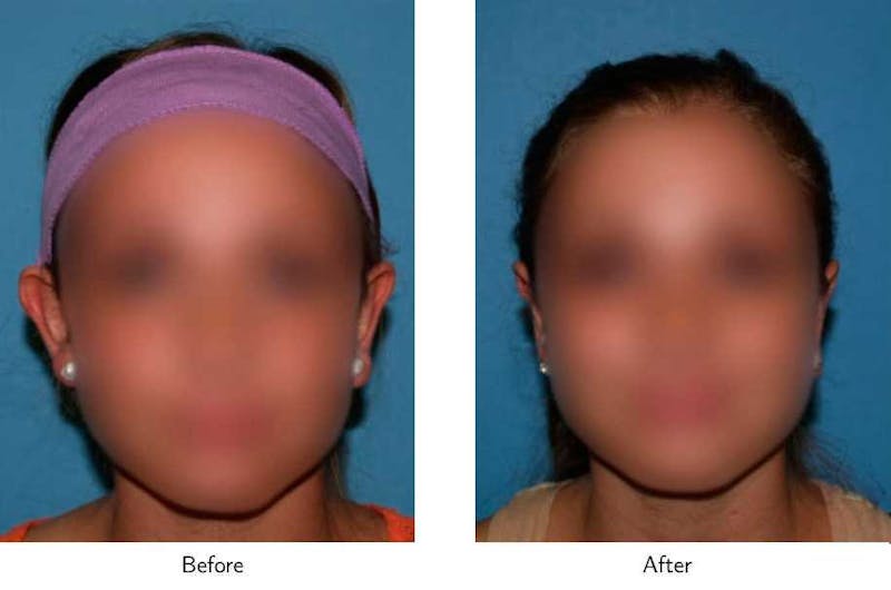 Ear Pinning (Otoplasty) Before & After Gallery - Patient 64081134 - Image 1