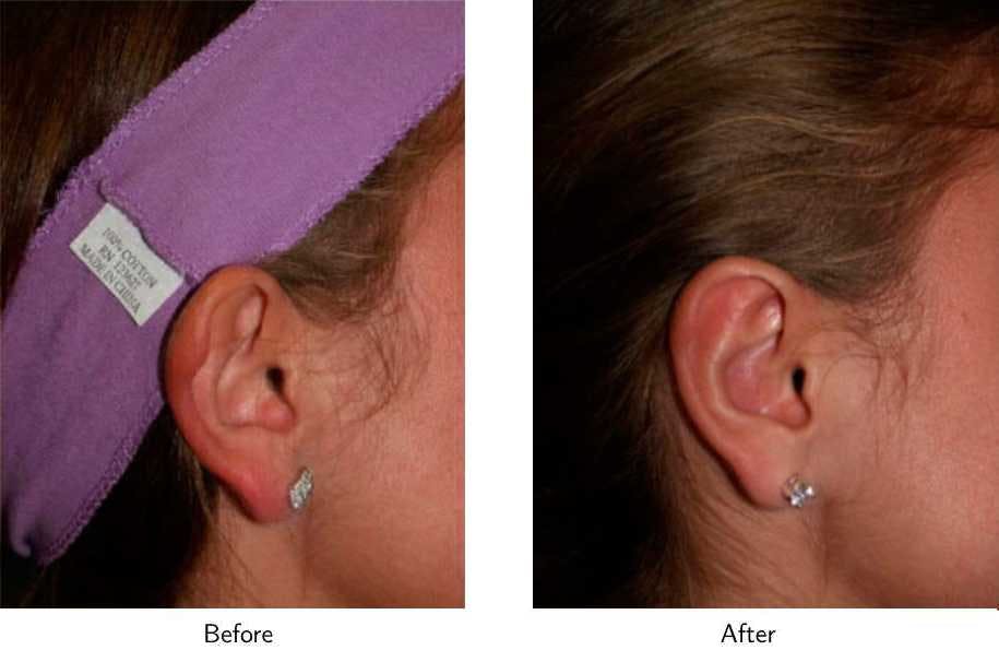 Ear Pinning (Otoplasty) Before & After Gallery - Patient 64081134 - Image 2