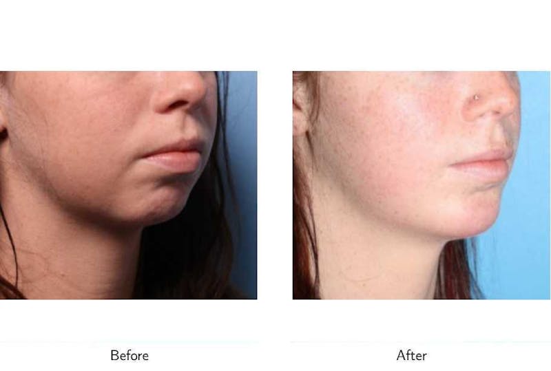 Chin Augmentation Before & After Gallery - Patient 64081133 - Image 1