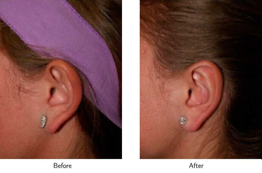 Ear Pinning (Otoplasty) Before & After Gallery - Patient 64081134 - Image 3