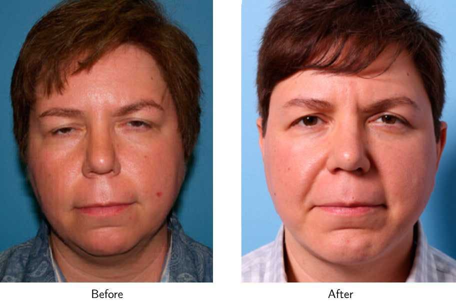 Chin Augmentation Before & After Gallery - Patient 64081137 - Image 1