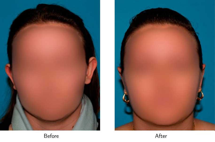 Ear Pinning (Otoplasty) Before & After Gallery - Patient 64081136 - Image 1