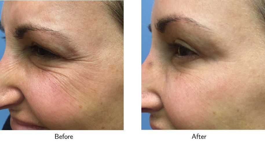 Wrinkle Treatments Before & After Gallery - Patient 64081135 - Image 1