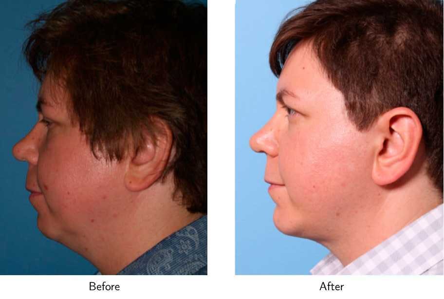 Chin Augmentation Before & After Gallery - Patient 64081137 - Image 2
