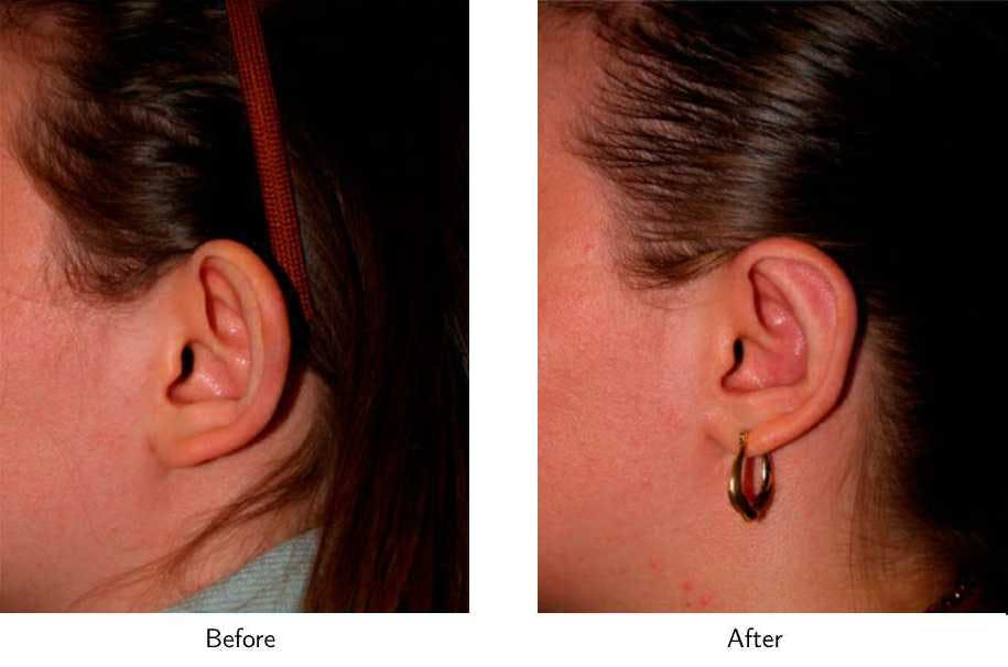 Ear Pinning (Otoplasty) Before & After Gallery - Patient 64081136 - Image 2