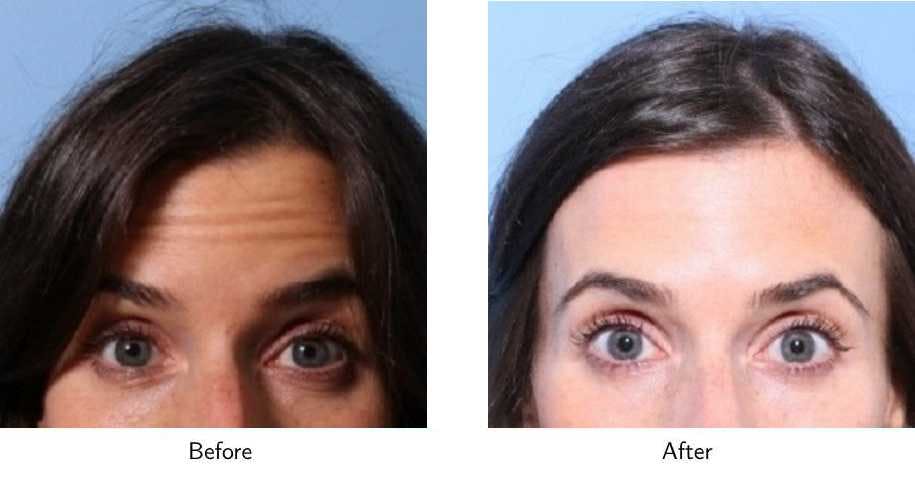 Wrinkle Treatments Before & After Gallery - Patient 64081138 - Image 1