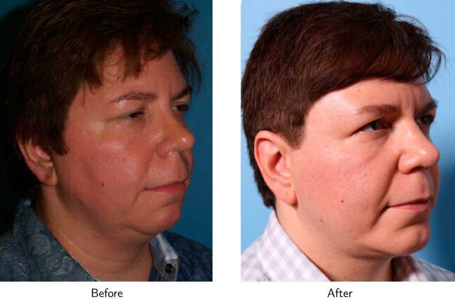Chin Augmentation Before & After Gallery - Patient 64081137 - Image 3