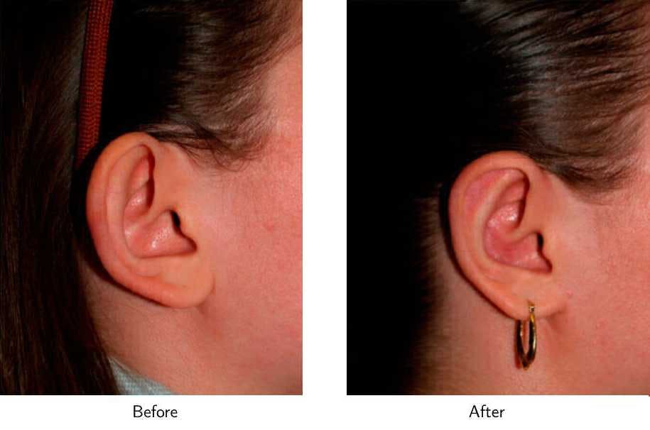 Ear Pinning (Otoplasty) Before & After Gallery - Patient 64081136 - Image 3
