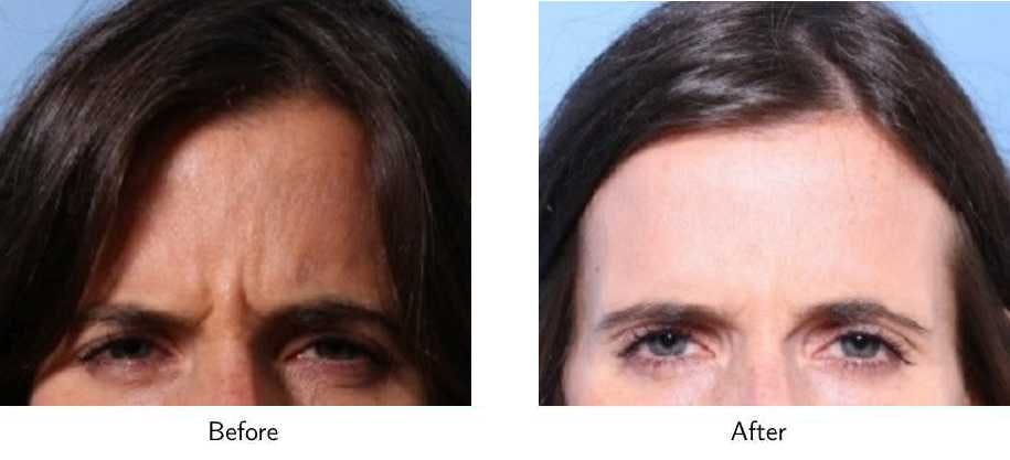 Wrinkle Treatments Before & After Gallery - Patient 64081138 - Image 2