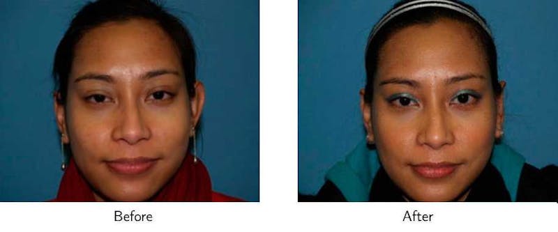 Ear Pinning (Otoplasty) Before & After Gallery - Patient 64081139 - Image 1