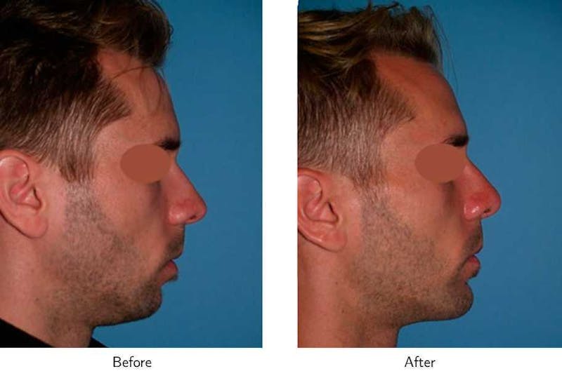 Chin Augmentation Before & After Gallery - Patient 64081141 - Image 1