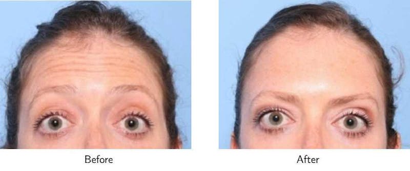 Wrinkle Treatments Before & After Gallery - Patient 64081140 - Image 1