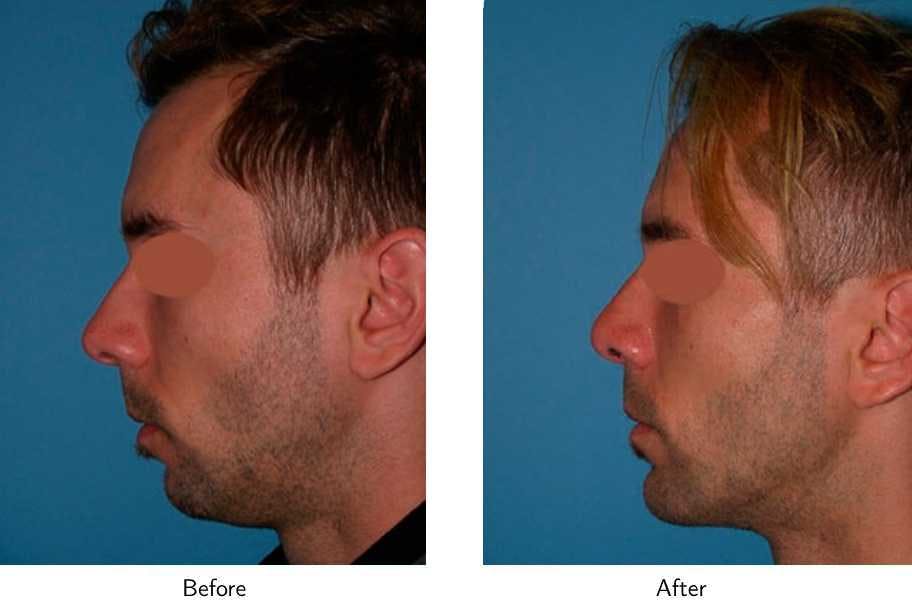 Chin Augmentation Before & After Gallery - Patient 64081141 - Image 2