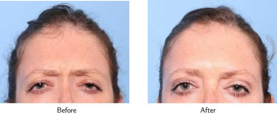 Wrinkle Treatments Before & After Gallery - Patient 64081140 - Image 2